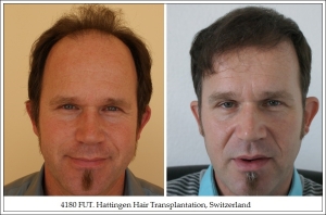1. 4180 FUT. Hattingen Hair Transplantation, Switzerland