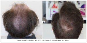 4. Before & Grown Out Result. 4920 FUT. Hattingen Hair Transplantation, Switzerland