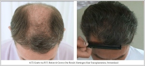 4172 Grafts via FUT. Before & Grown Out Result. Hattingen Hair Transplantation, Switzerland