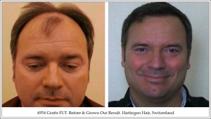 4954 Grafts FUT. Before & Grown Out Result. Hattingen Hair, Switzerland