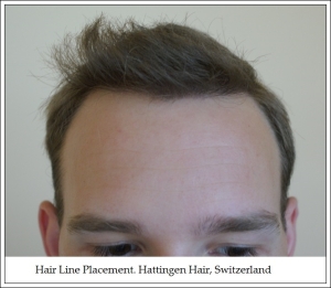 6. Hair Line Placement. Hattingen Hair, Switzerland
