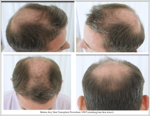 Before Any Hair Transplant Procedure. NW5