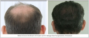Before & Grown Out Result. 4172 Grafts via FUT. Hatingen Hair Transplantation, Switzerland