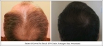 Before & Grown Out Result. 4954 Grafts. Hattingen Hair, Switzerland