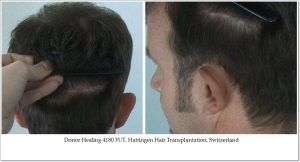 Donor Healing 4180 FUT. Hattingen Hair Transplantation, Switzerland