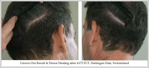 Grown Out Result & Donor Healing after 4172 FUT. Hattingen Hair, Switzerland