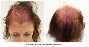 2236 Graft Placement. Hattingen Hair, Switzerland