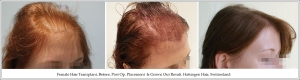 Female Hair Transplant, Before, Post Op. Placement  & Grown Out Result. Hattingen Hair, Switzerland